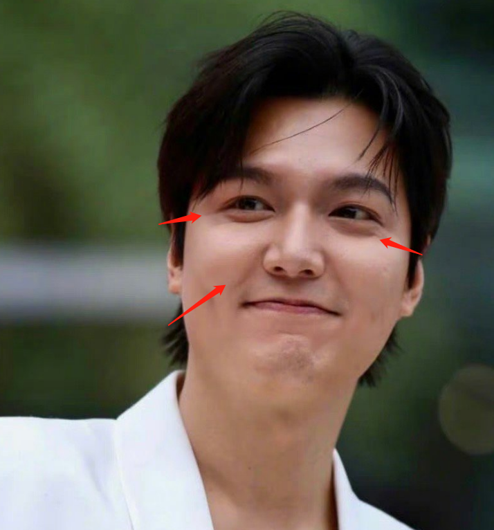 图9: 李敏镐李敏镐最新生图不敢认!脸颊胖到像气球,疑似整容后遗症爆发